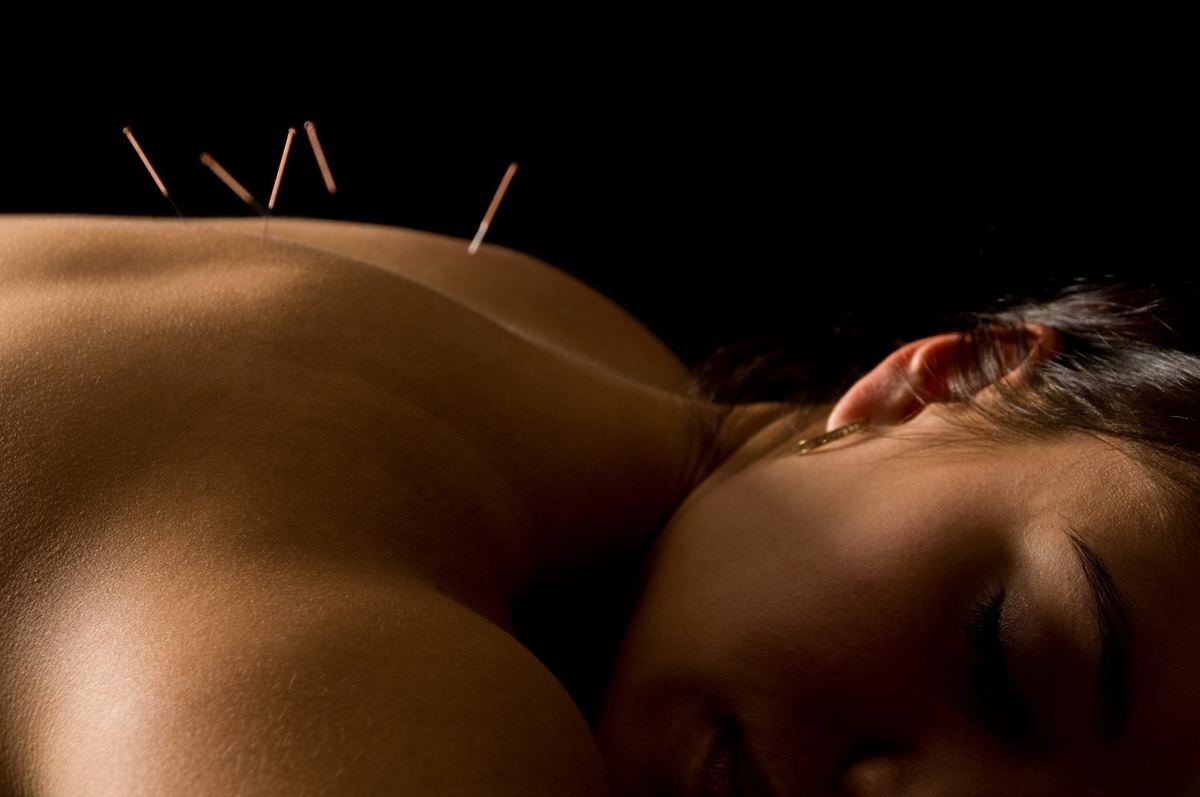 Woman getting an acupuncture treatment in a spa